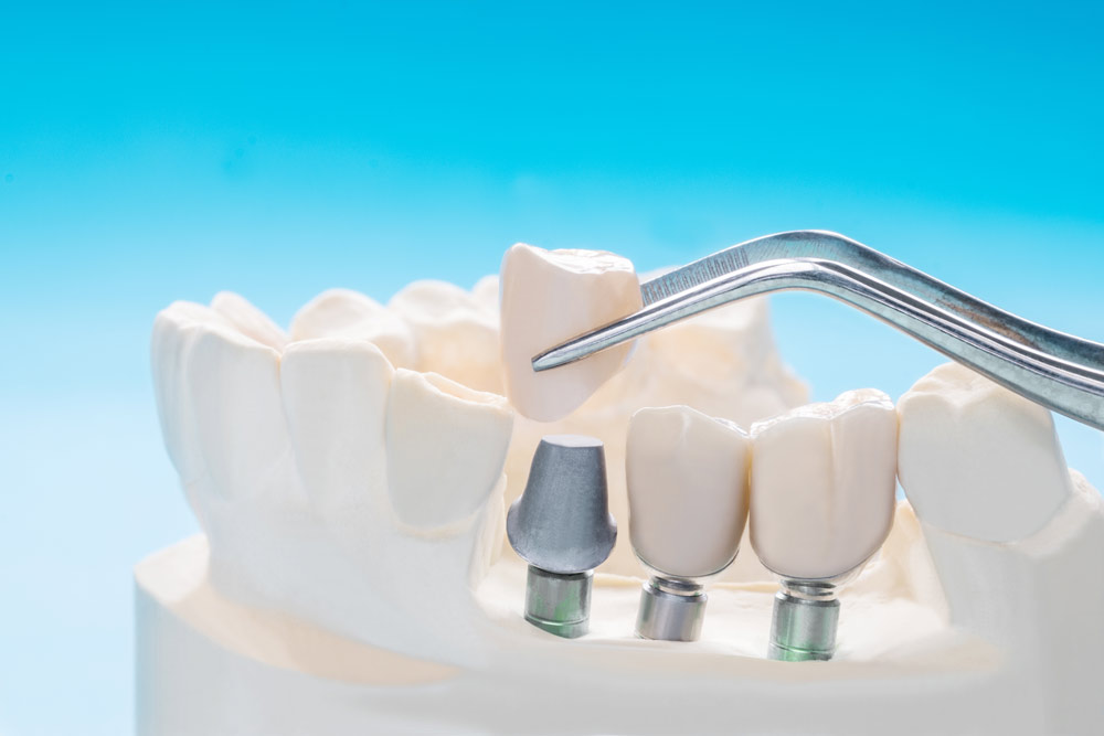 tooth implants by Beaverton dentist